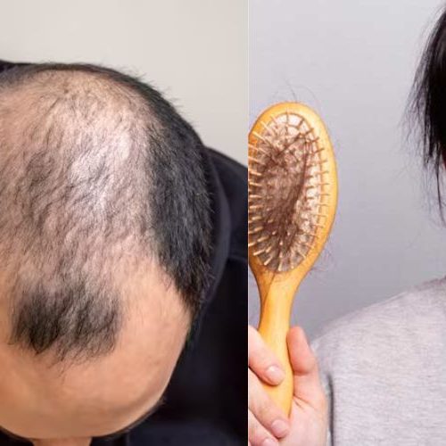 बालों का झड़ना कैसे रोके एवं इसके देसी नुस्खे या घरेलू उपाय